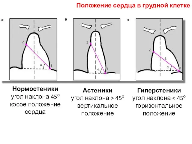 Гиперстеники угол наклона Нормостеники угол наклона 45о косое положение сердца