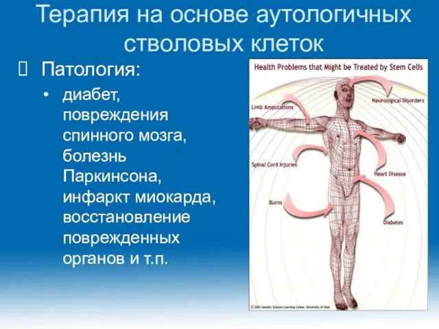 Терапия на основе аутологичных стволовых клеток Патология: диабет, повреждения спинного