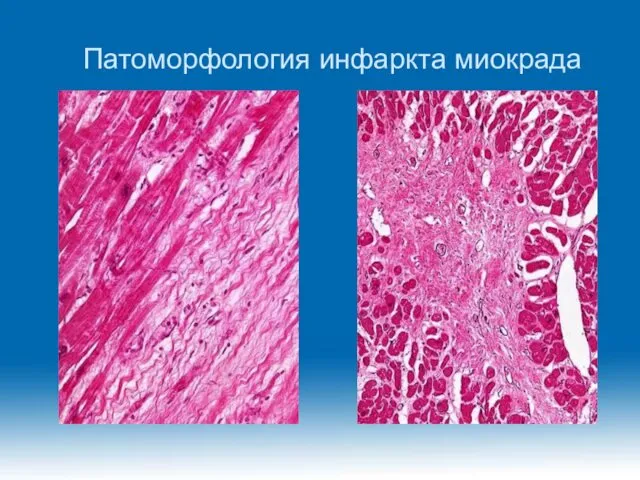 Патоморфология инфаркта миокрада