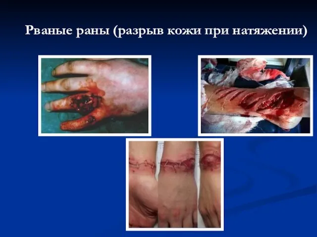 Рваные раны (разрыв кожи при натяжении)