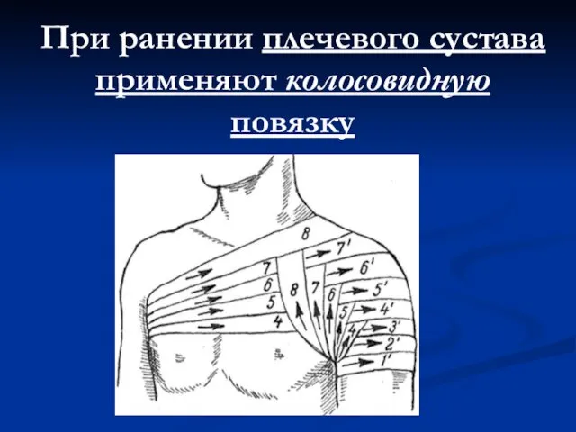 При ранении плечевого сустава применяют колосовидную повязку
