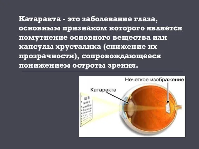 Катаракта - это заболевание глаза, основным признаком которого является помутнение