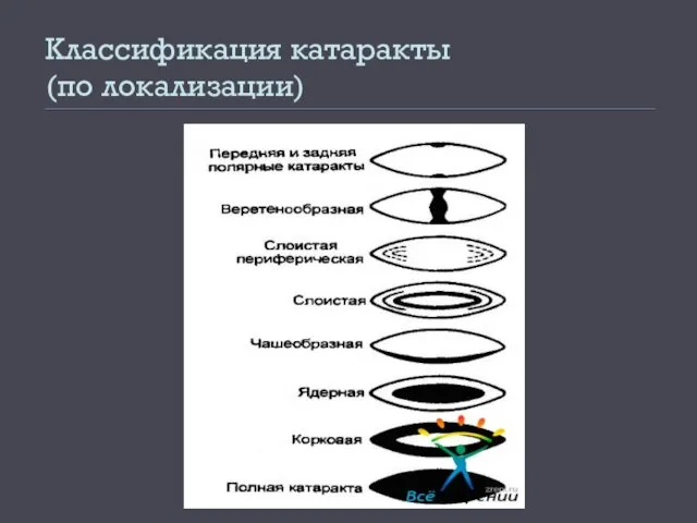 Классификация катаракты (по локализации)