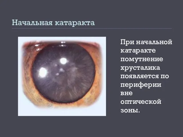 Начальная катаракта При начальной катаракте помутнение хрусталика появляется по периферии вне оптической зоны.