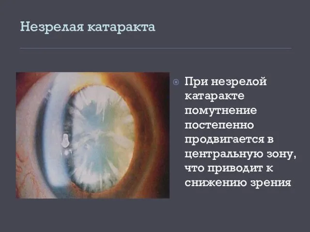 Незрелая катаракта При незрелой катаракте помутнение постепенно продвигается в центральную зону, что приводит к снижению зрения