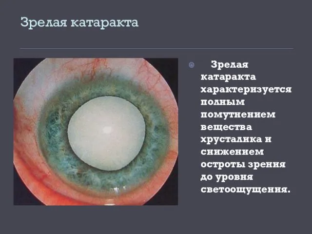 Зрелая катаракта Зрелая катаракта характеризуется полным помутнением вещества хрусталика и снижением остроты зрения до уровня светоощущения.