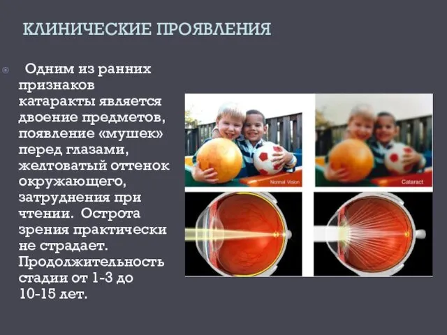 КЛИНИЧЕСКИЕ ПРОЯВЛЕНИЯ Одним из ранних признаков катаракты является двоение предметов,
