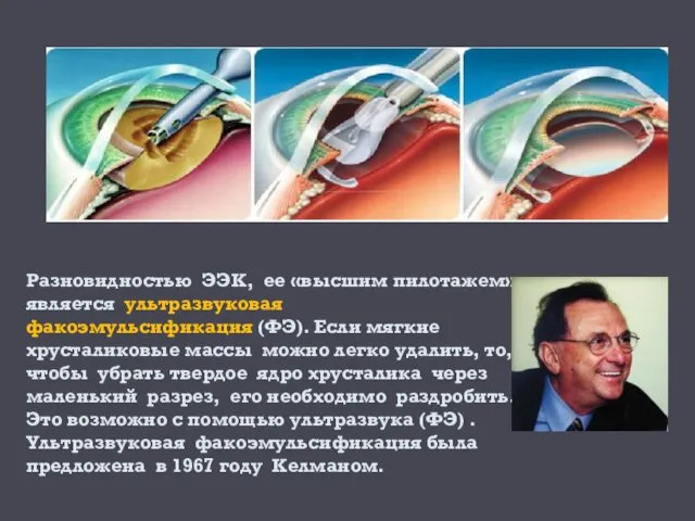 Разновидностью ЭЭК, ее «высшим пилотажем» является ультразвуковая факоэмульсификация (ФЭ). Если