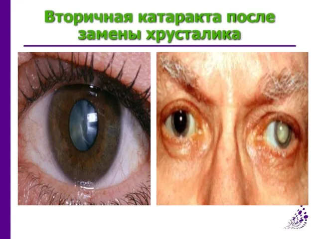 Вторичная катаракта после замены хрусталика