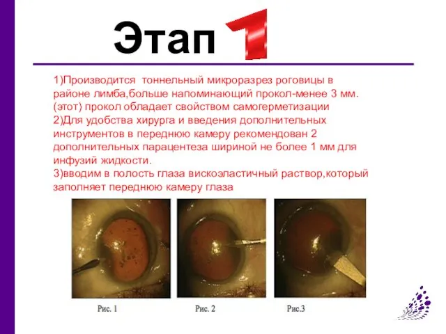 Этап 1)Производится тоннельный микроразрез роговицы в районе лимба,больше напоминающий прокол-менее