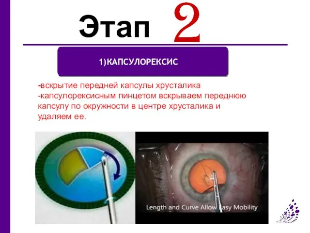 Этап 1)КАПСУЛОРЕКСИС -вскрытие передней капсулы хрусталика -капсулорексисным пинцетом вскрываем переднюю капсулу по окружности
