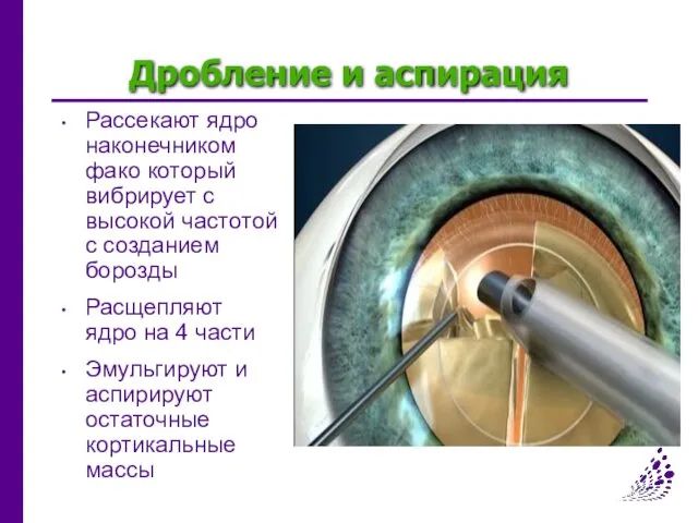 Дробление и аспирация Рассекают ядро наконечником фако который вибрирует с высокой частотой с