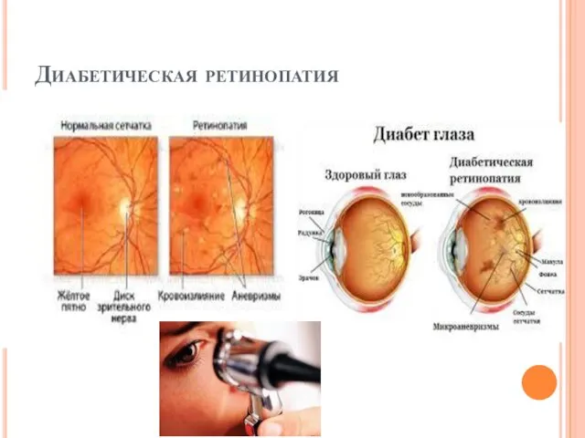 Диабетическая ретинопатия