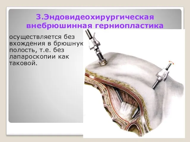 3.Эндовидеохирургическая внебрюшинная герниопластика осуществляется без вхождения в брюшную полость, т.е. без лапароскопии как таковой.