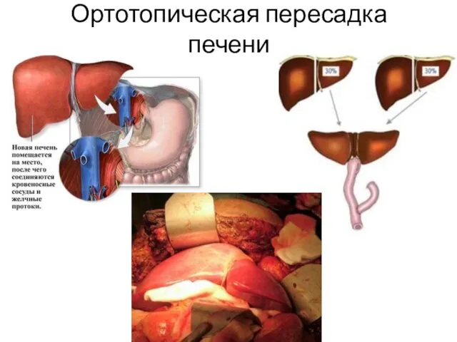 Ортотопическая пересадка печени