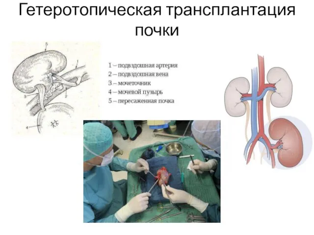 Гетеротопическая трансплантация почки