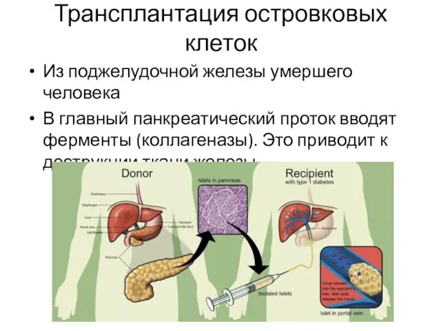 Трансплантация островковых клеток Из поджелудочной железы умершего человека В главный панкреатический проток вводят