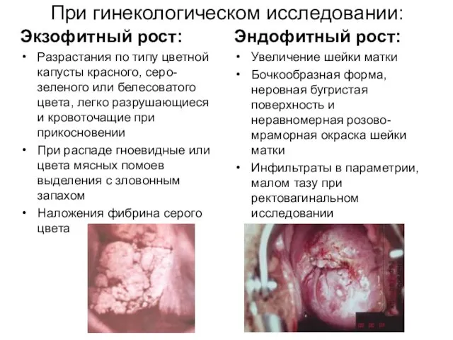 При гинекологическом исследовании: Экзофитный рост: Разрастания по типу цветной капусты красного, серо-зеленого или