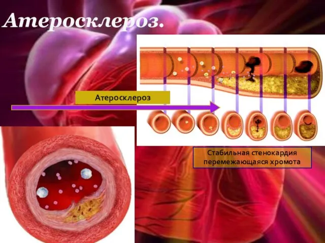 Атеросклероз. Атеросклероз Стабильная стенокардия перемежающаяся хромота