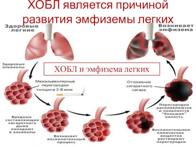 ХОБЛ является причиной развития эмфиземы легких ХОБЛ и эмфизема легких