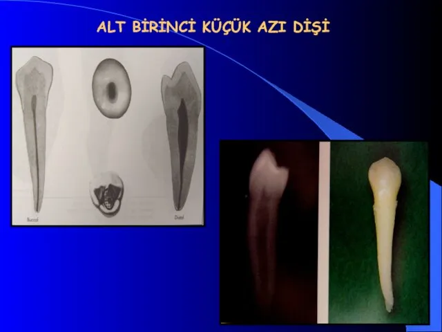 ALT BİRİNCİ KÜÇÜK AZI DİŞİ