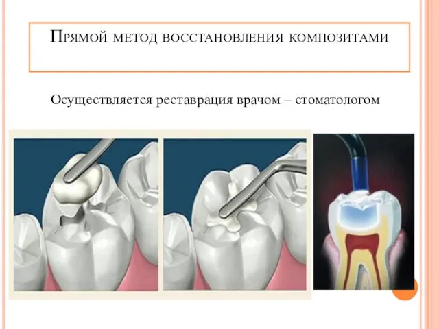 Прямой метод восстановления композитами Осуществляется реставрация врачом – стоматологом