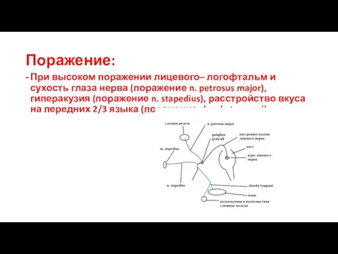 Поражение: При высоком поражении лицевого– логофтальм и сухость глаза нерва