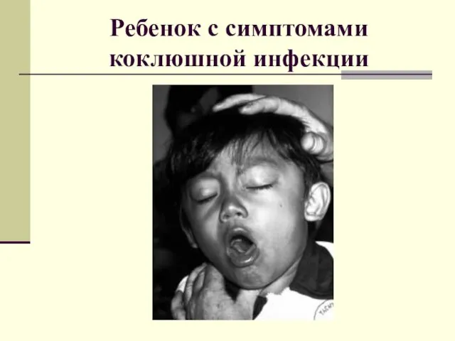 Ребенок с симптомами коклюшной инфекции