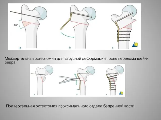 Межвертельная остеотомия для варусной деформации после перелома шейки бедра. Подвертельная остеотомия проксимального отдела бедренной кости