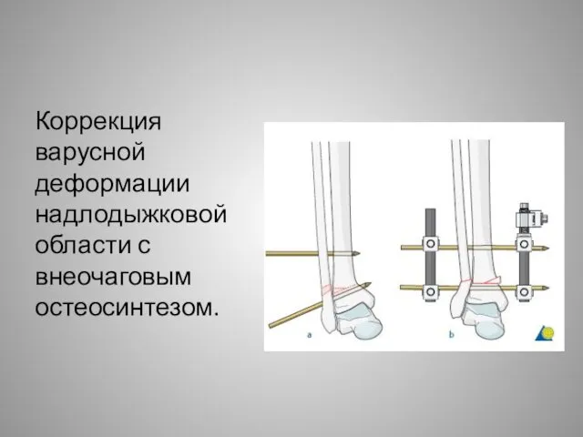 Коррекция варусной деформации надлодыжковой области с внеочаговым остеосинтезом.