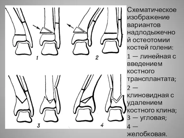 Схематическое изображение вариантов надлодыжечной остеотомии костей голени: 1 — линейная