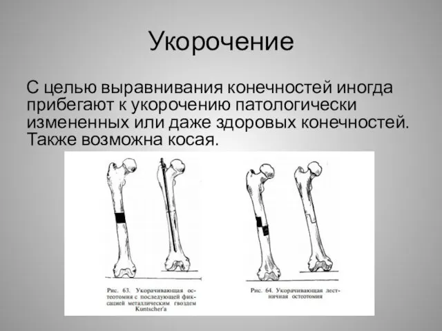 Укорочение С целью выравнивания конечностей иногда прибегают к укорочению патологически