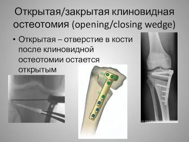 Открытая/закрытая клиновидная остеотомия (opening/closing wedge) Открытая – отверстие в кости после клиновидной остеотомии остается открытым