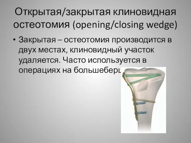 Открытая/закрытая клиновидная остеотомия (opening/closing wedge) Закрытая – остеотомия производится в