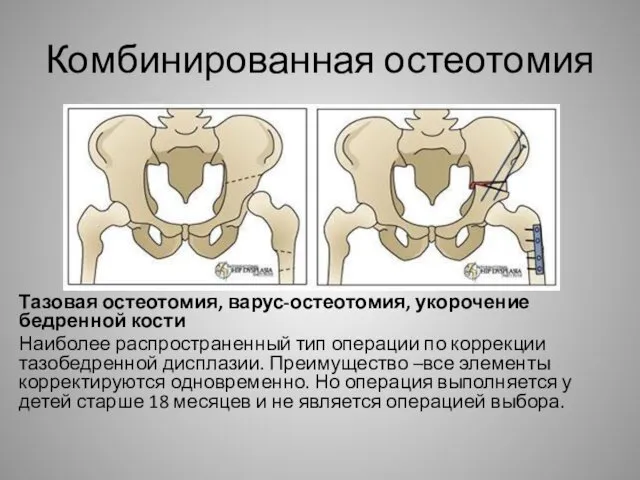 Комбинированная остеотомия Тазовая остеотомия, варус-остеотомия, укорочение бедренной кости Наиболее распространенный