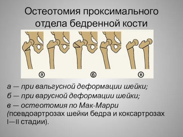 Остеотомия проксимального отдела бедренной кости а — при вальгусной деформации