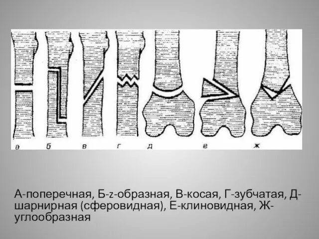 А-поперечная, Б-z-образная, В-косая, Г-зубчатая, Д-шарнирная (сферовидная), Е-клиновидная, Ж-углообразная