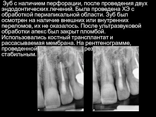 Зуб с наличием перфорации, после проведения двух эндодонтических лечений. Была