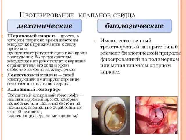 Протезирование клапанов сердца Шариковый клапан — протез, в котором шарик