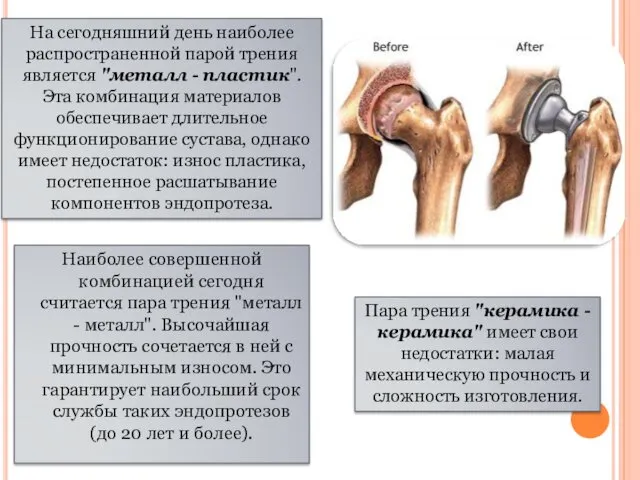 Наиболее совершенной комбинацией сегодня считается пара трения "металл - металл".