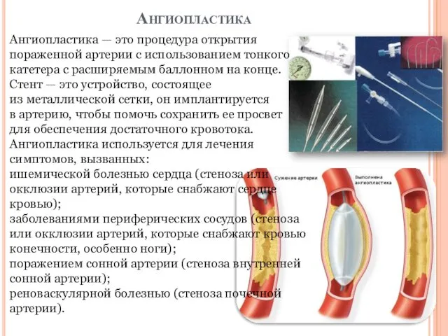 Ангиопластика Ангиопластика — это процедура открытия пораженной артерии с использованием