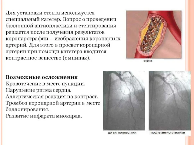 Для установки стента используется специальный катетер. Вопрос о проведении баллонной