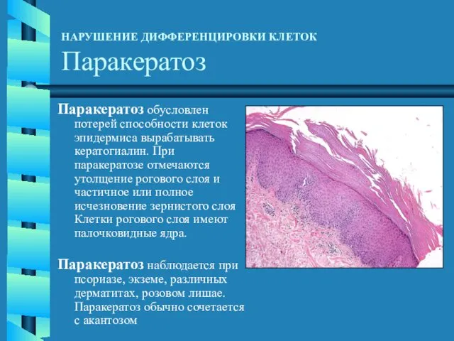 НАРУШЕНИЕ ДИФФЕРЕНЦИРОВКИ КЛЕТОК Паракератоз Паракератоз обусловлен потерей способности клеток эпидермиса