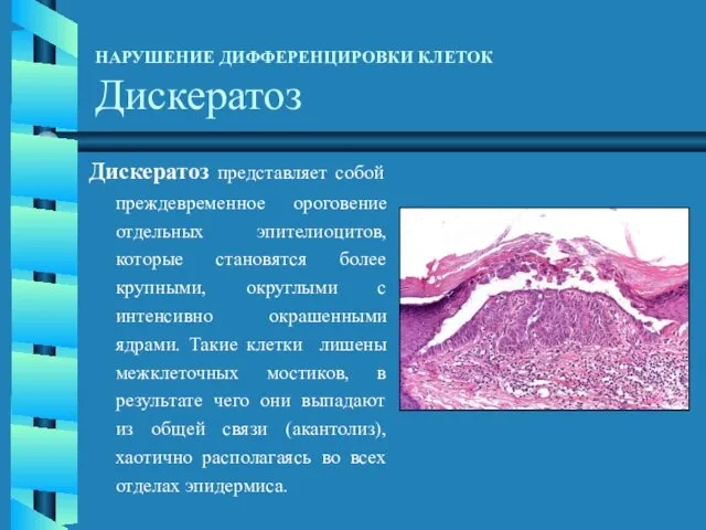 НАРУШЕНИЕ ДИФФЕРЕНЦИРОВКИ КЛЕТОК Дискератоз Дискератоз представляет собой преждевременное ороговение отдельных