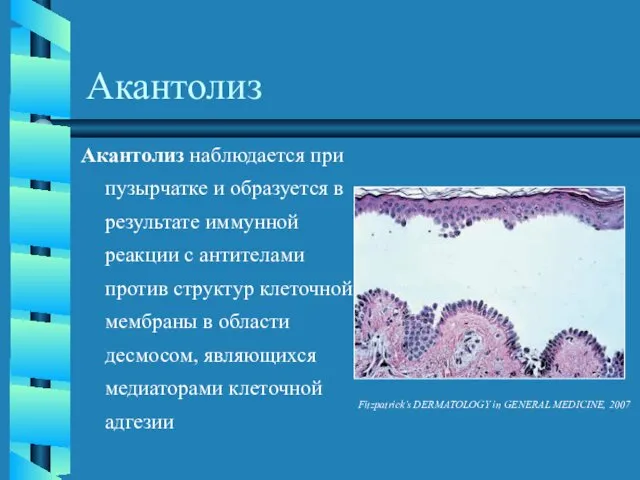 Акантолиз Акантолиз наблюдается при пузырчатке и образуется в результате иммунной