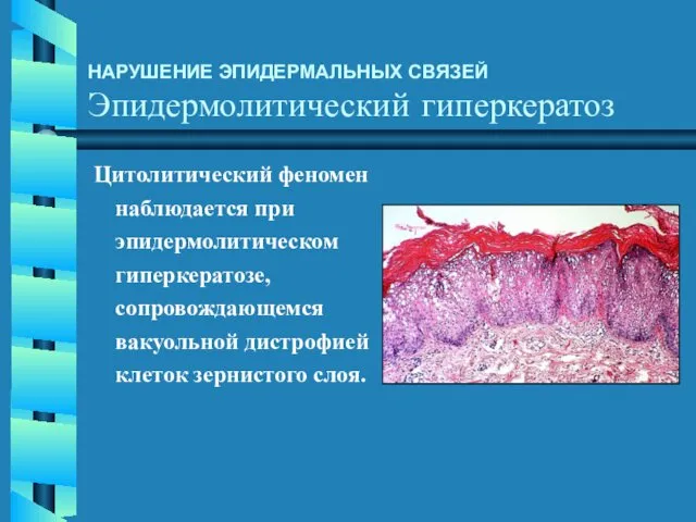 НАРУШЕНИЕ ЭПИДЕРМАЛЬНЫХ СВЯЗЕЙ Эпидермолитический гиперкератоз Цитолитический феномен наблюдается при эпидермолитическом