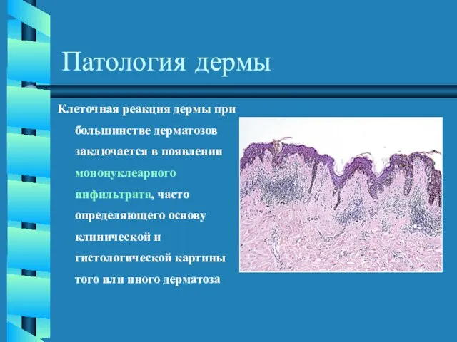 Патология дермы Клеточная реакция дермы при большинстве дерматозов заключается в