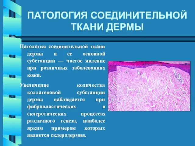 Патология соединительной ткани дермы и ее основной субстанции — частое