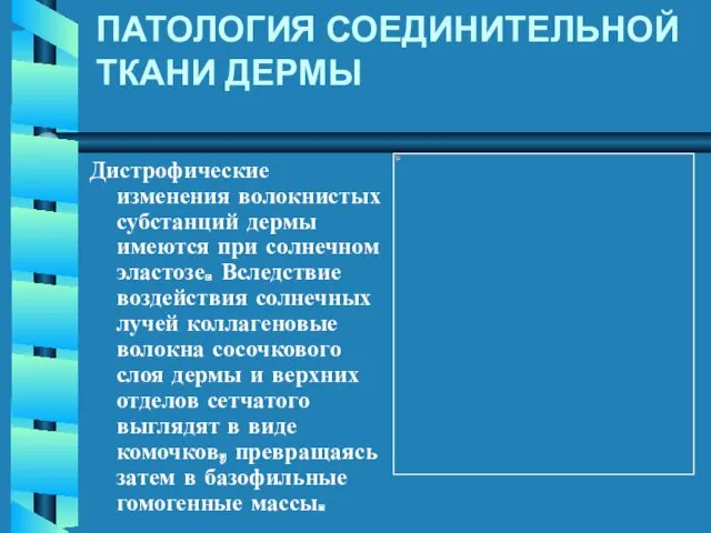 ПАТОЛОГИЯ СОЕДИНИТЕЛЬНОЙ ТКАНИ ДЕРМЫ Дистрофические изменения волокнистых субстанций дермы имеются