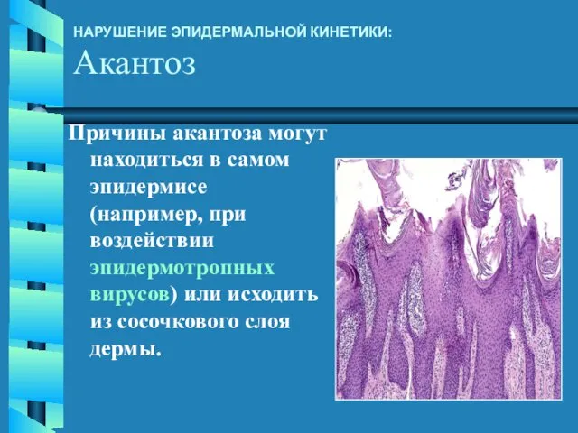 НАРУШЕНИЕ ЭПИДЕРМАЛЬНОЙ КИНЕТИКИ: Акантоз Причины акантоза могут находиться в самом